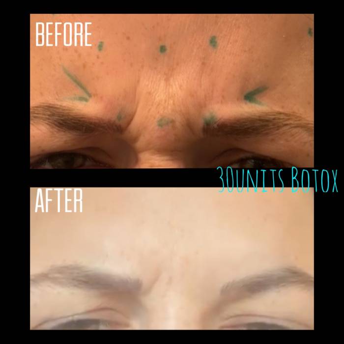 Botox Forehead Patient 1 | Delta Phoenix Medical Spa  Gallery Image