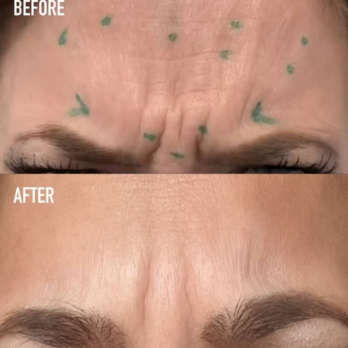 Botox Forehead Patient 3 | Delta Phoenix Medical Spa  Gallery Image