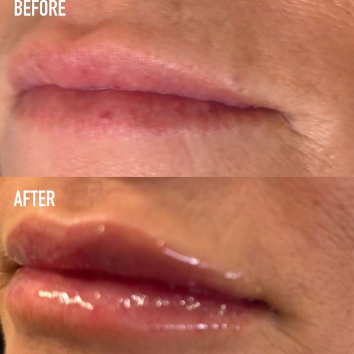 Botox Lip Patient 2 | Delta Phoenix Medical Spa  Gallery Image